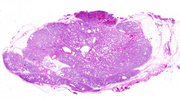 1A1 Hemangioma, Capillary (Case 1)  1