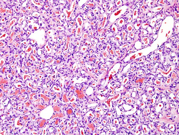 1A2 Hemangioma, Capillary (Case 1)  3