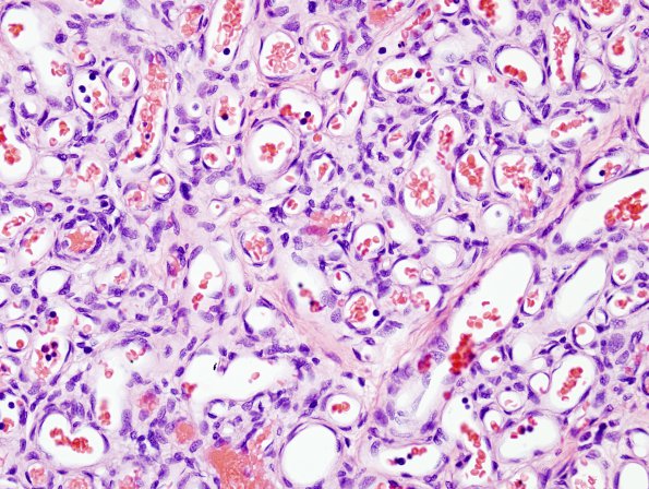 1A3 Hemangioma, Capillary (Case 1)  2