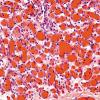 1A4 Hemangioma, Capillary (Case 1)  4