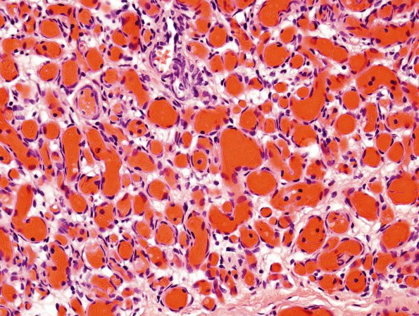 1A4 Hemangioma, Capillary (Case 1)  4