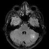 4A1 Capillary hemangioma (Case 4) FLAIR - Copy