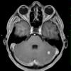 4A2 Capillary hemangioma (Case 4) T1 W 2 - Copy