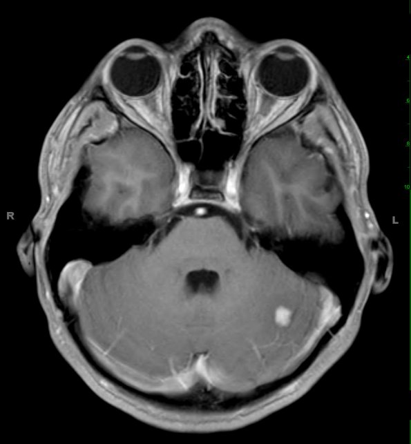 4A2 Capillary hemangioma (Case 4) T1 W 2 - Copy