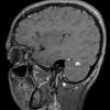 4A4 Vascular malformation (Case 4) T1 W 4 - Copy