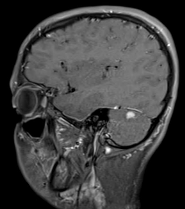 4A4 Vascular malformation (Case 4) T1 W 4 - Copy