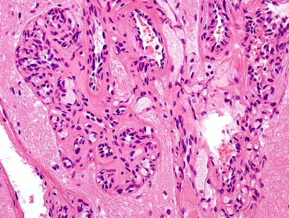 4B3 Capillary hemangioma (Case 4) H&E 5