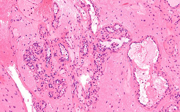 4B5 Capillary hemangioma (Case 4) A2 H&E 20X