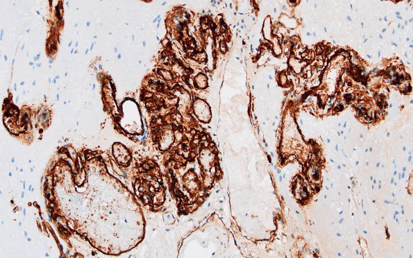 4C3 Capillary hemangioma (Case 4) A2 CD34 20X