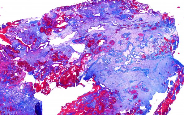 4D1 Capillary hemangioma (Case 4) A2 Trichrome 2X