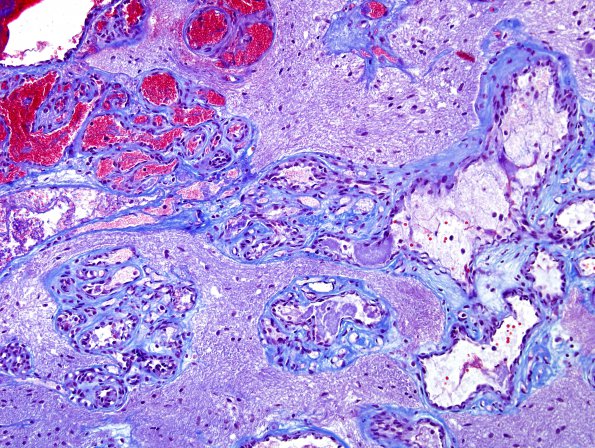 4D4 Capillary hemangioma (Case 4) Trichrome 2