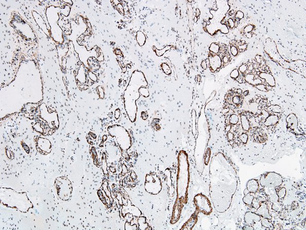 4E2 Capillary hemangioma (Case 4) SMA 4