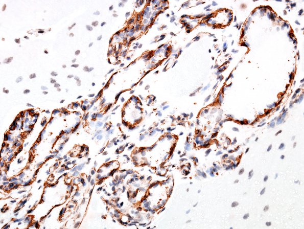 4E3 Capillary hemangioma (Case 4) SMA 6