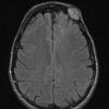 5A1 Hemangioma (Case 5) FLAIR 1 - Copy