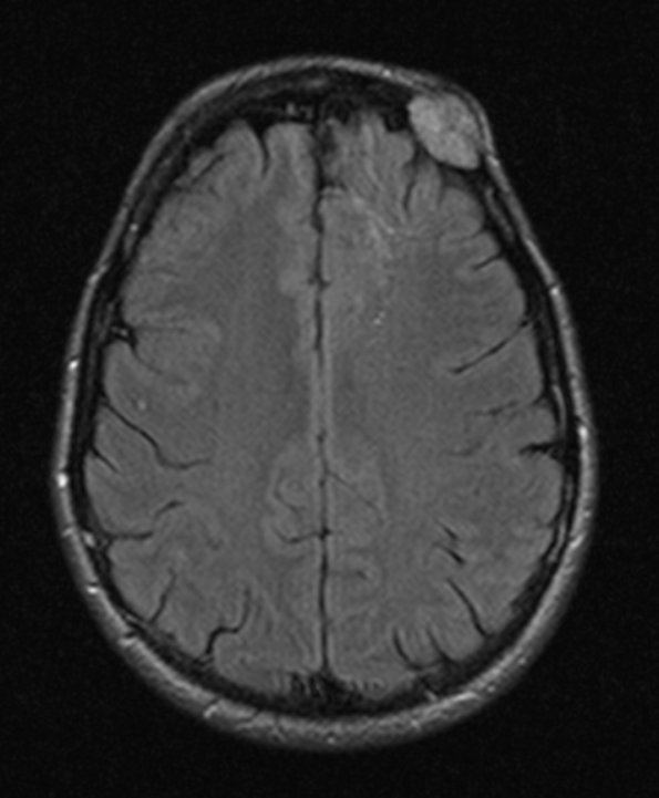 5A1 Hemangioma (Case 5) FLAIR 1 - Copy