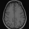 5A2 Hemangioma (Case 5) T1 without C - Copy