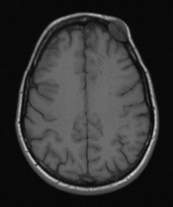 5A2 Hemangioma (Case 5) T1 without C - Copy