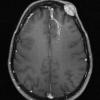 5A3 Hemangioma (Case 5) T1 with C - Copy