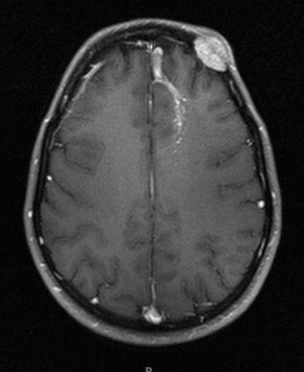 5A3 Hemangioma (Case 5) T1 with C - Copy