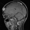 5A4 Hemangioma (Case 5) T1 with C 2 - Copy