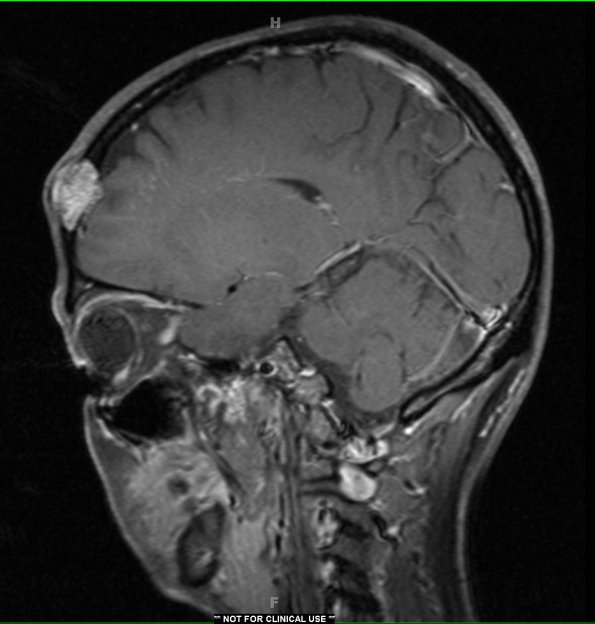 5A4 Hemangioma (Case 5) T1 with C 2 - Copy