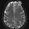 5A5 Hemangioma (Case 5) T2 without C - Copy