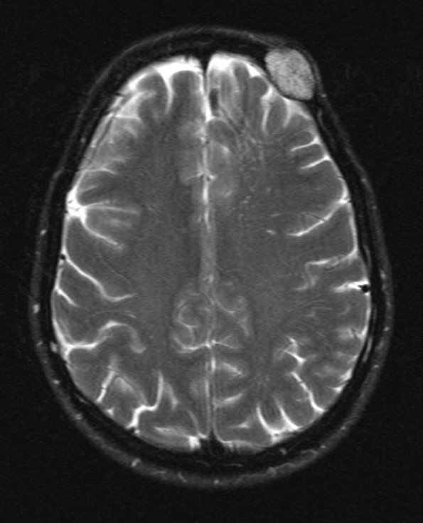 5A5 Hemangioma (Case 5) T2 without C - Copy