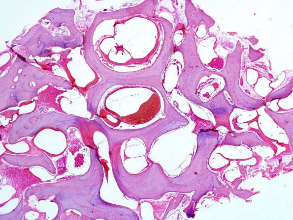 5C2 Hemangioma (Case 5) H&E 2