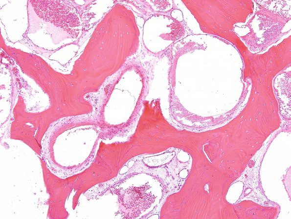 5C3 Hemangioma, skull (Case 5) H&E 3