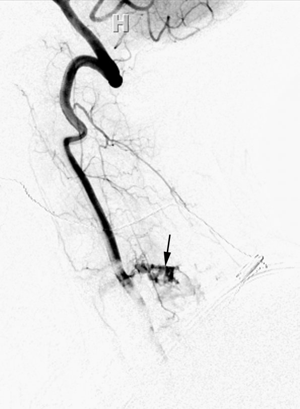 6A1 Hemangioma (Case 6) R Vert Angio (1-18-2016) copy