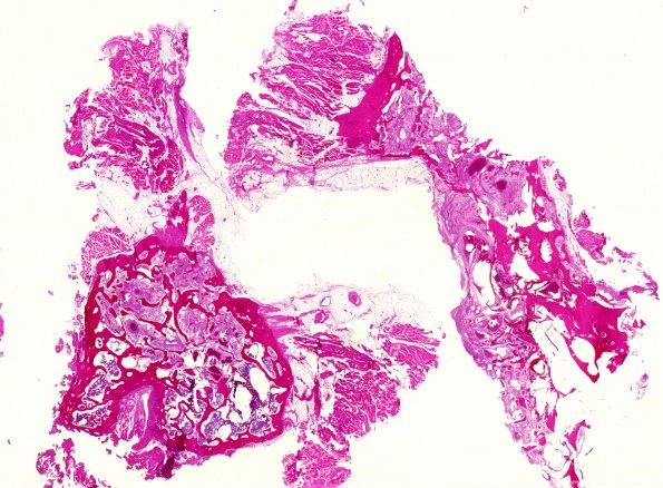 6B1 Hemangioma (Case 6) H&E whole mount