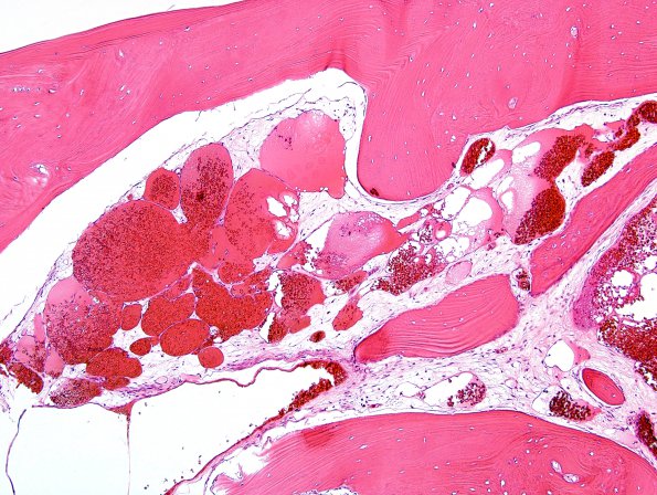 6B2 Hemangioma (Case 6) H&E 11