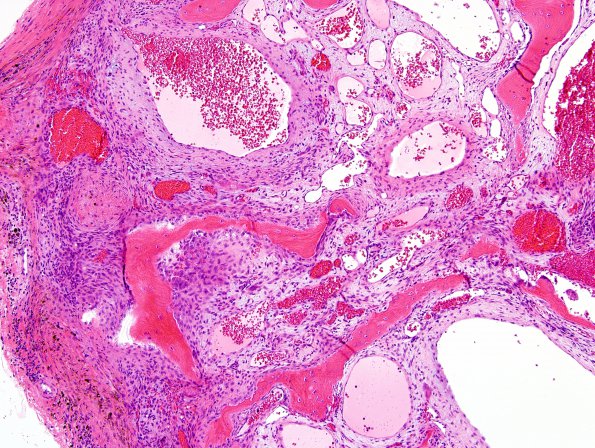 6B3 Hemangioma (Case 6) H&E 9