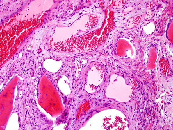 6B4 Hemangioma (Case 6) H&E 2