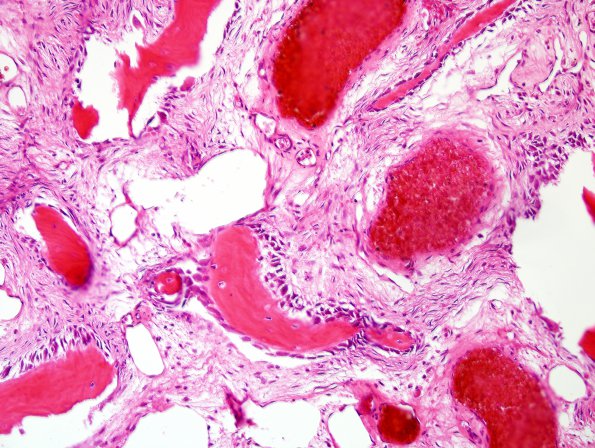 6B5 Hemangioma (Case 6) H&E 6