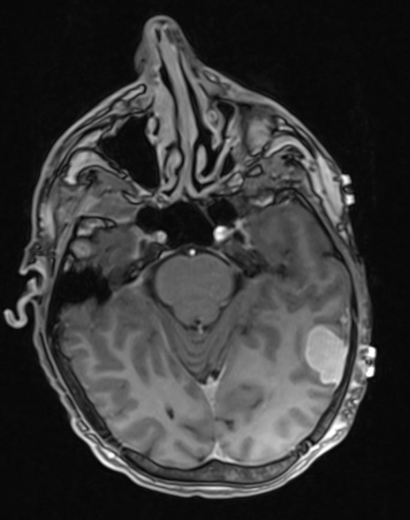 7A1 Hemangioma (Case 7) T1 MPRAGE 1 - Copy