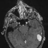 7A2 Hemangioma (Case 7) T1 1 - Copy