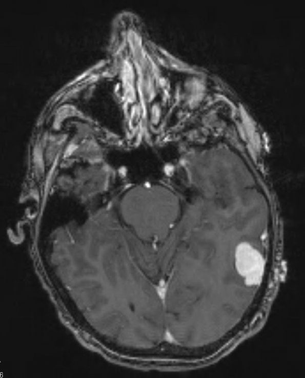 7A2 Hemangioma (Case 7) T1 1 - Copy