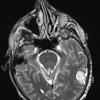 7A3 Hemangioma (Case 7) T2 1 - Copy