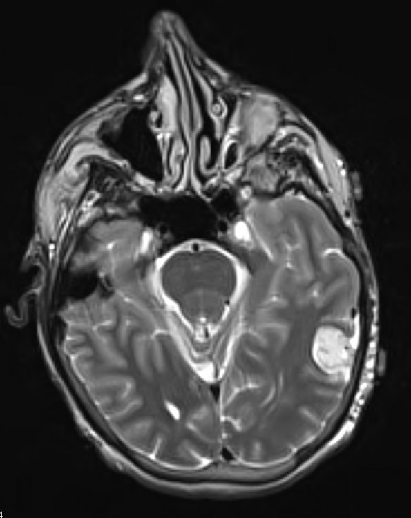 7A3 Hemangioma (Case 7) T2 1 - Copy