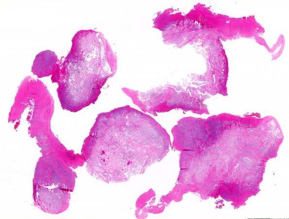 7B1 Hemangioma (Case 7) H&E WM