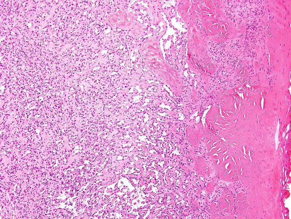 7B2 Hemangioma (Case 7) H&E 3