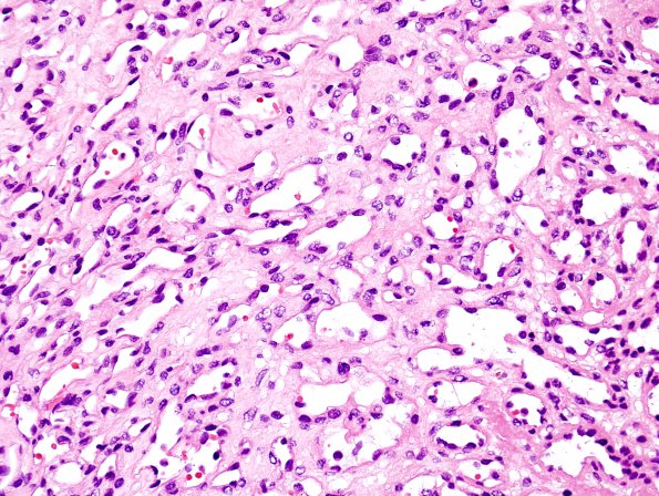 7B3 Hemangioma (Case 7) H&E 5