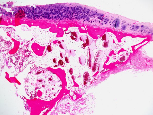 8A1 Hemangioma (Case 8) H&E whole mount