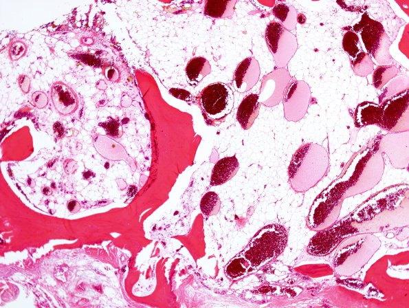 8A2 Hemangioma, vertebral bone (Case 8) H&E 1