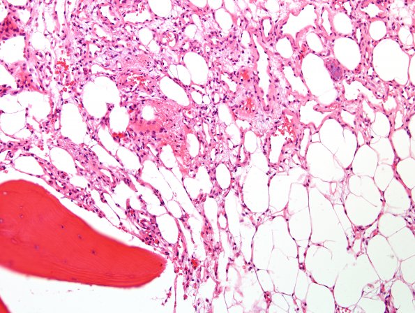 8A3 Hemangioma, vertebral bone (Case 8) H&E 2