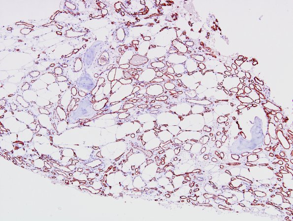 8B Hemangioma, vertebral bone (Case 8) CD34 2