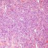 9A1 Hemangioma (Case 9) H&E 2