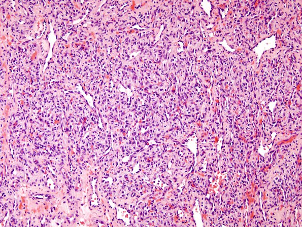 9A1 Hemangioma (Case 9) H&E 2