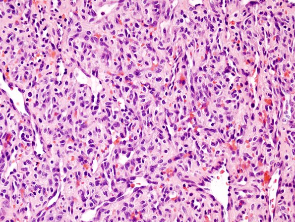 9A2 Hemangioma (Case 9) H&E 1